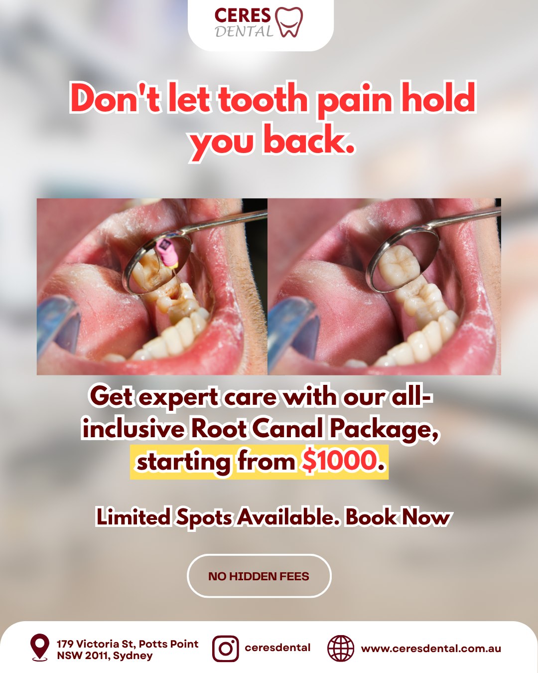 Root Canal Package